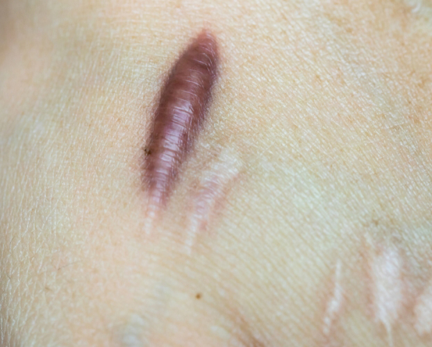 Trị Sẹo Lồi Tại Sen Beauty